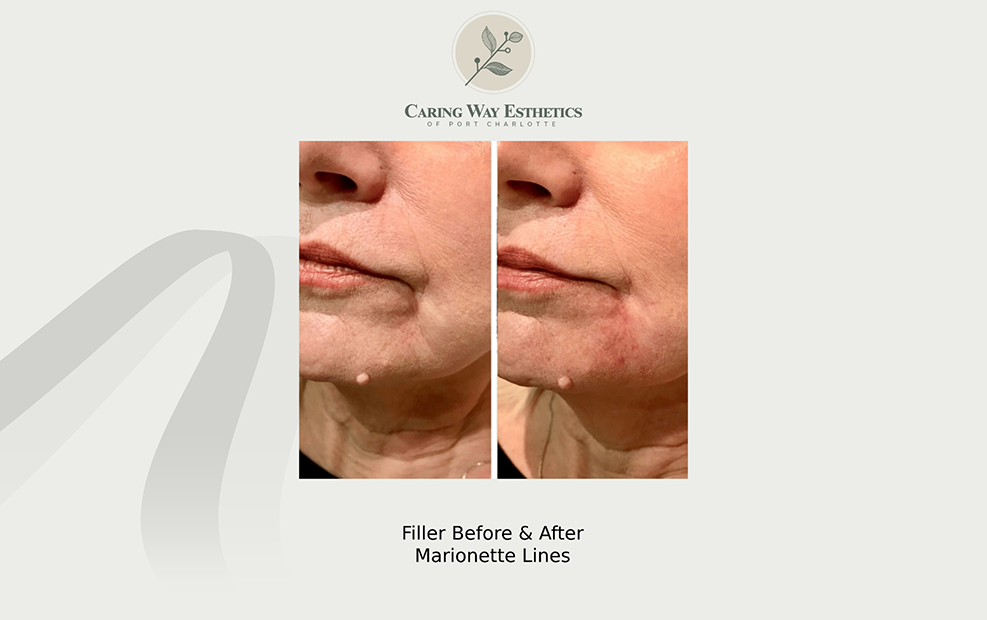 Senior woman before and after getting filler treatment