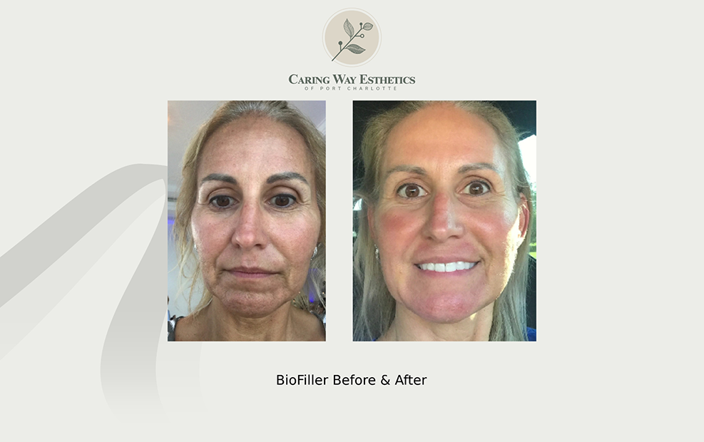 Woman before and after smoothing her skin with BioFiller esthetic treatment