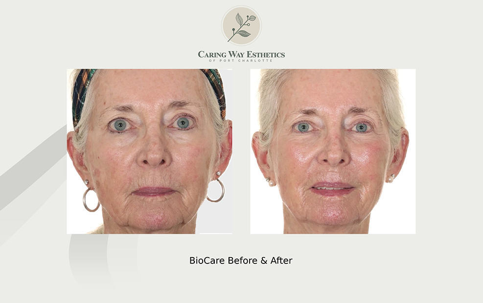 Older woman before and after smoothing her skin with BioCare