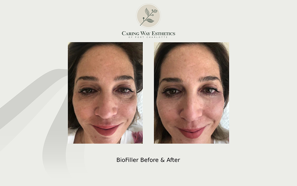 Brunette woman smiling before and after esthetic treatment