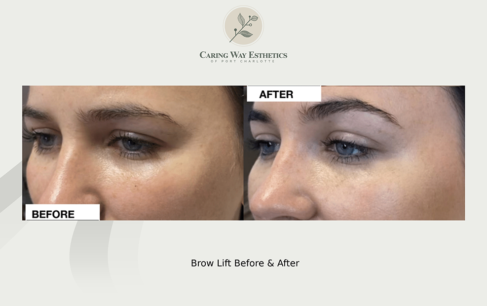 Womans eyes before and after getting a brow lift