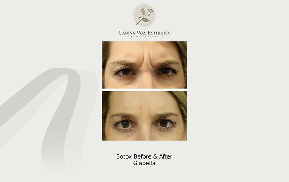 Upper half of a womans face before and after treating glabella wrinkles with Botox