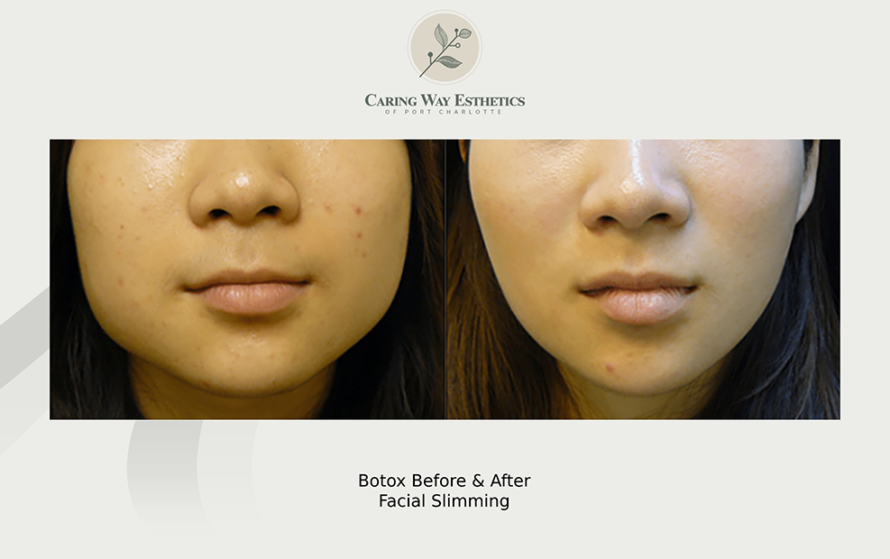 Lower half of a womans face before and after facial slimming with Botox