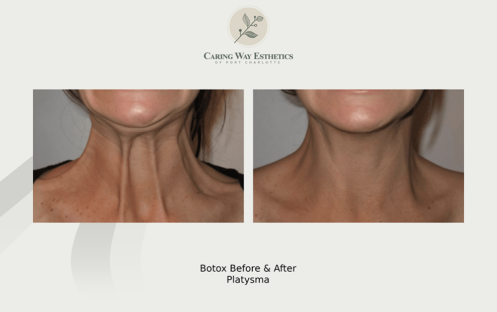 Womans neck before and after wrinkle treatment with Platysma