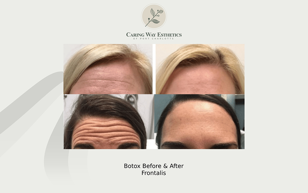 Two womens foreheads before and after wrinkle treatment with Botox