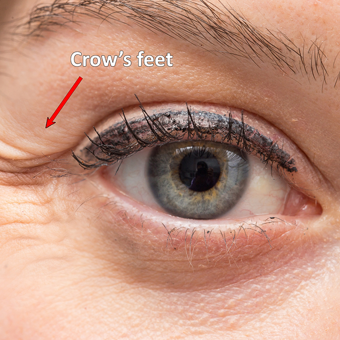 Close up of an eye with an arrow pointing to the crows feet next to it