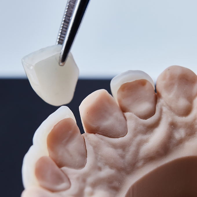 A veneer being placed over the front of a tooth in a model of the mouth