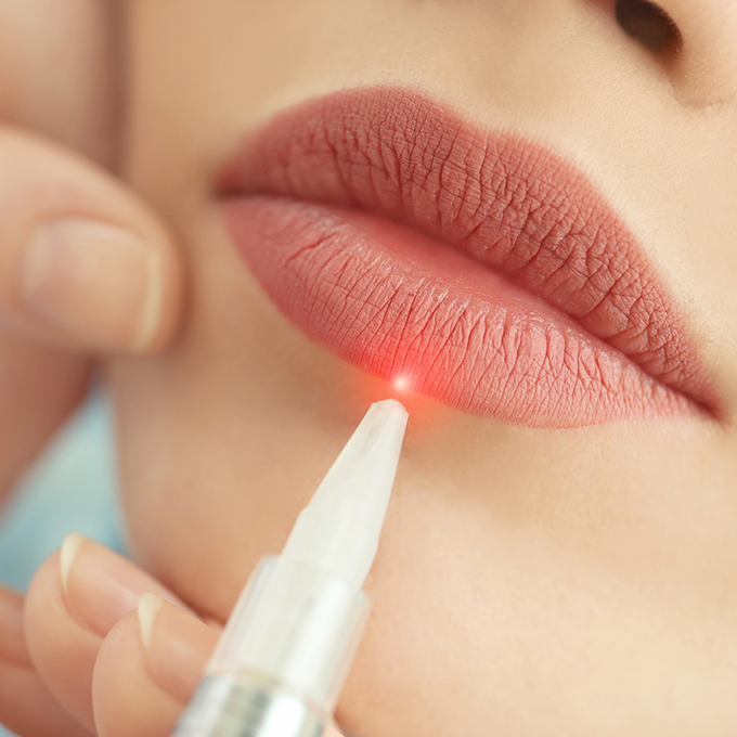 Close up of a Fotona laser device treating a persons lips