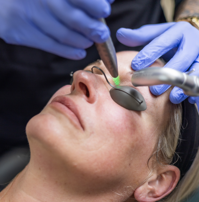Esthetic patient receiving a Fotona laser treatment near their eye