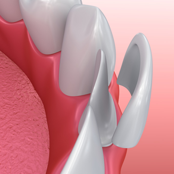 Illustration of veneer on bottom teeth