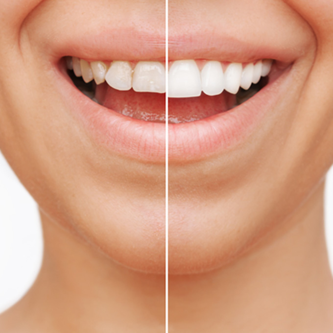 Patient's smile before and after veneers