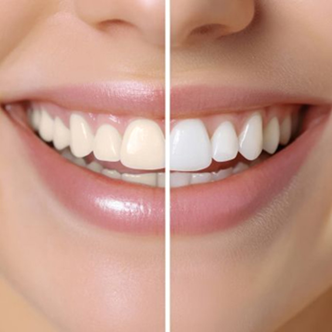 Close-up of woman’s smile before and after teeth whitening