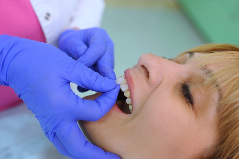 A dentist placing veneers on a patient’s teeth